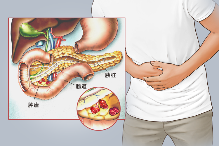 51岁男子每天大便两三次，确诊胰腺癌！6种异常或是身体“警报”